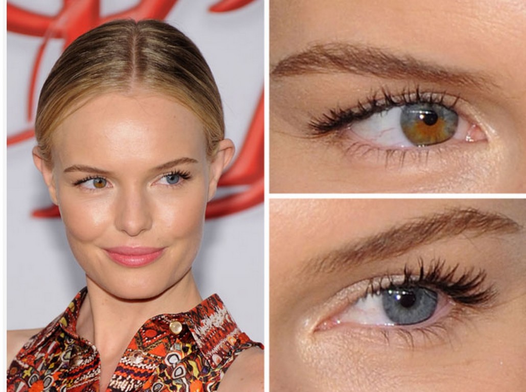 Mosaicismo somatico - Kate Bosworth