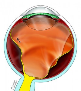 disegno a colori di un caso di Distacco di retina
